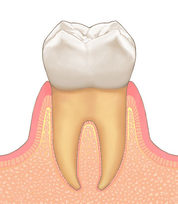 歯周病の進行｜1