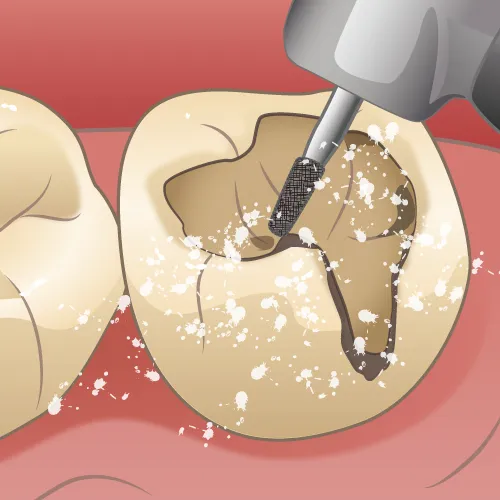 コンポジットレジン(ＣＲ)プラスチックの一種